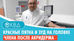 ? Красные пятна и зуд на головке члена после акридерма. Клинический случай №714