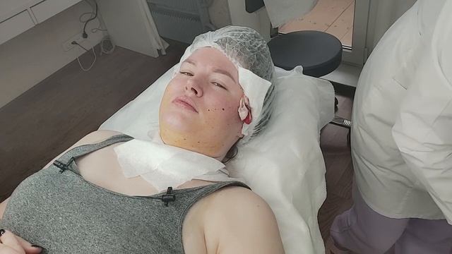 ?Улётный нитевой лифтинг лица, нити коги (COG) в Зеленограде. Салон красоты в Зеленограде.