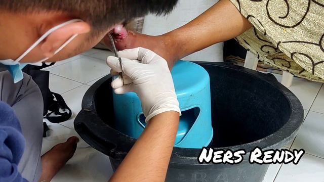PELUK55, Perawatan luka diabetes di jari kaki смотреть онлайн