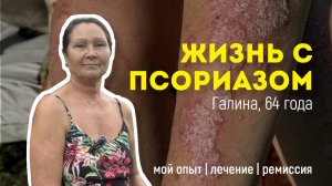 Лечение псориаза - моя история