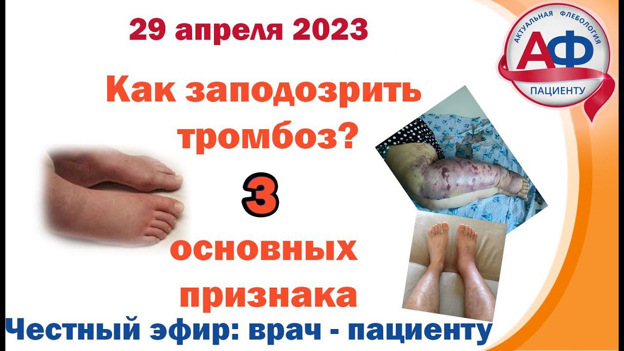 Как заподозрить тромбоз: 3 основных признака!