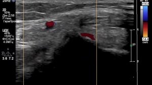 УЗИ сосудов нижних конечностей