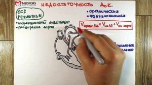 Аортальная недостаточность - "Просто о сложном"