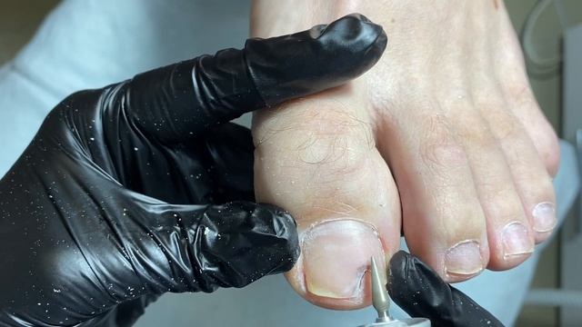 Педикюр, зачистка гематомы смотреть онлайн