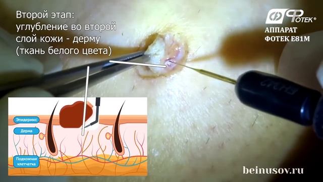 Эксцизионная биопсия пигментного невуса кожи голени методом широкополосной радиоволновой хирургии