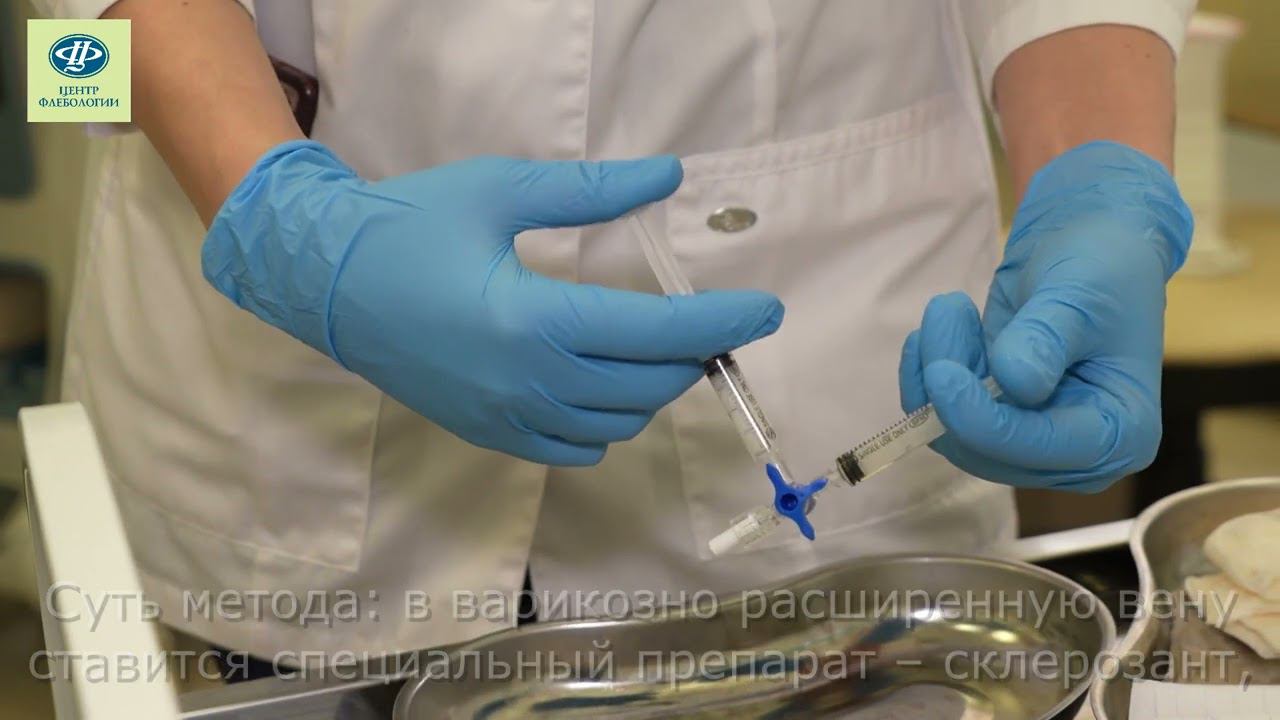 Склеротерапия варикозных вен в Тюмени