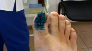 перевязка пальца