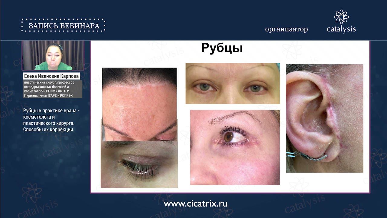 Вебинар: Рубцы в практике косметолога и пластического хирурга. Способы коррекции. смотреть онлайн