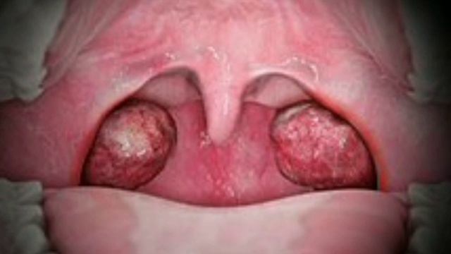 Lymph node causes & treatment /Tuberculosis/galy ki giltia aor ilaj/Lymphatic system/@rahmancare смотреть онлайн