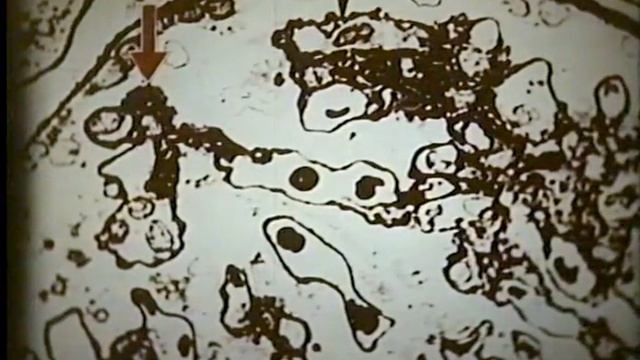 Пункционная биопсия почки, нефрит © biopsy of the kidney, nephritis смотреть онлайн