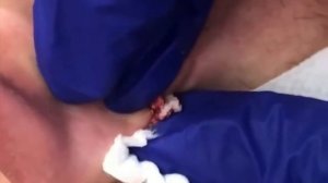 Давим Прищи угри подборка видео