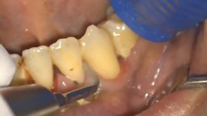 Удаление зубного камня