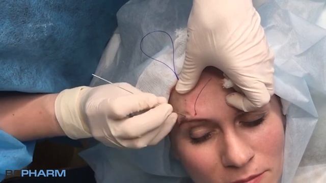 Коррекция зоны бровей лифтинговыми нитями смотреть онлайн