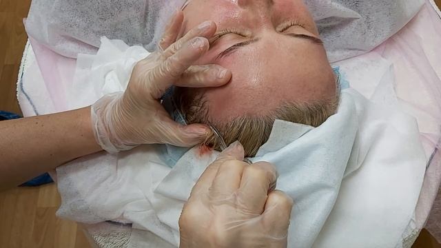 АирисКом студенты учатся: применение нитей Коги для лифтинга височной области. смотреть онлайн
