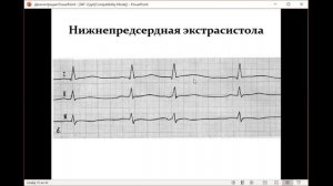 ЭКГ - электрокардиограмма (формат ответа и разбор примеров). (ДЛЯ СТУДЕНТОВ)