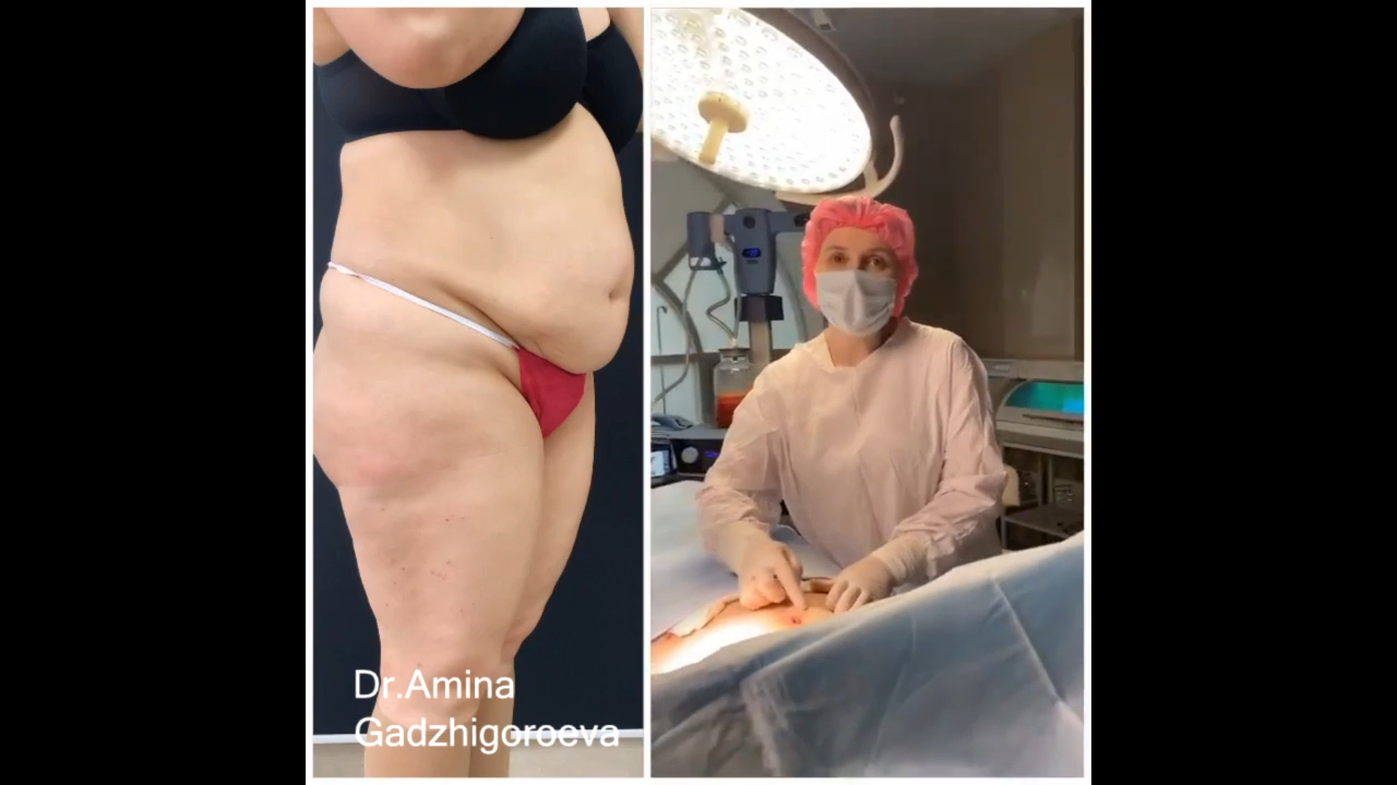 Абдоминопластика до и после смотреть онлайн