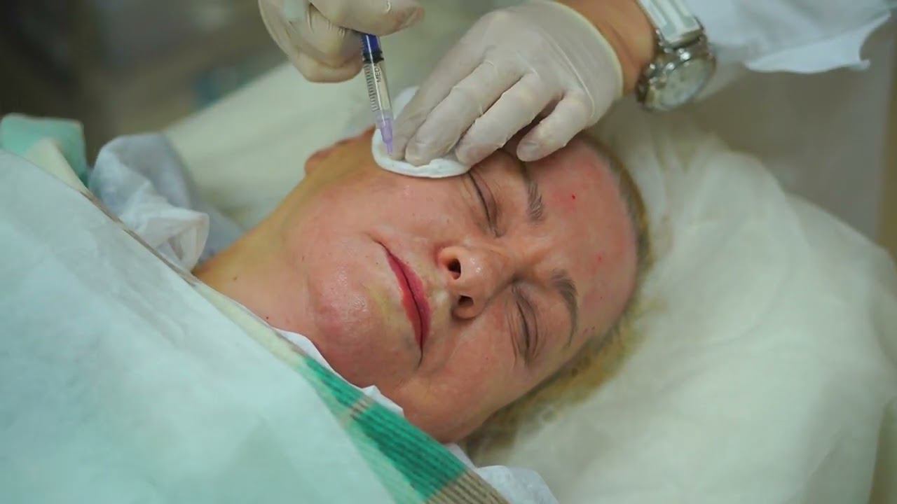 Коллагенотерапия Linerase смотреть онлайн