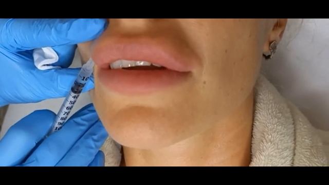 гиалуронидазы