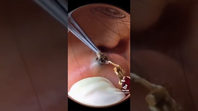 Акне, Гнойный прыщ. #акне #прыщи #pimple смотреть онлайн