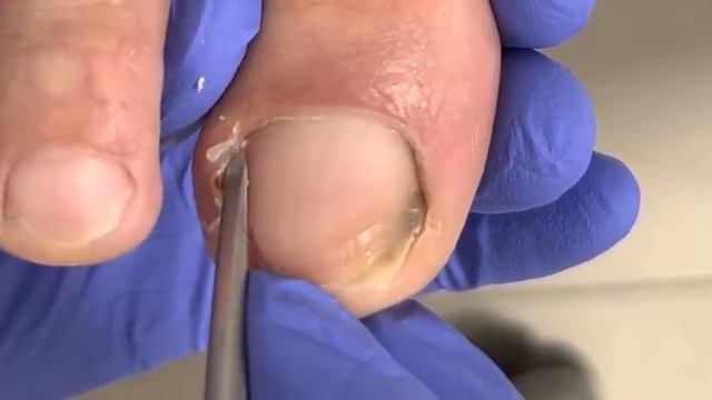Pedicure Tutorial: Visible Dirt Under Toenails【Xue Yidao】