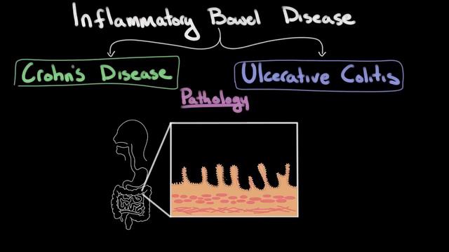 Inflammatory bowel disease: Epidemiology & pathology | NCLEX-RN | Khan Academy смотреть онлайн