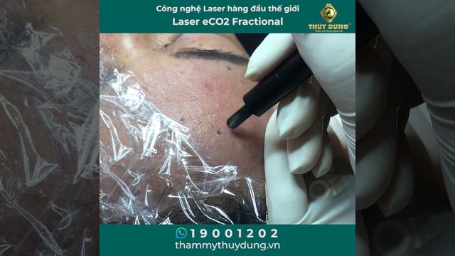 Điều trị mụn thịt 2020 смотреть онлайн