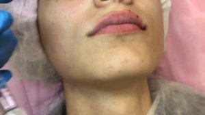 Увеличение губ: папоротниковая и парижская техника. 1ml.