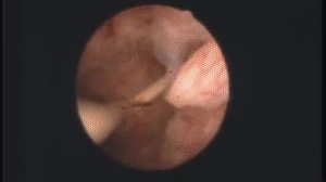 Спираль в матке. Заглянем?