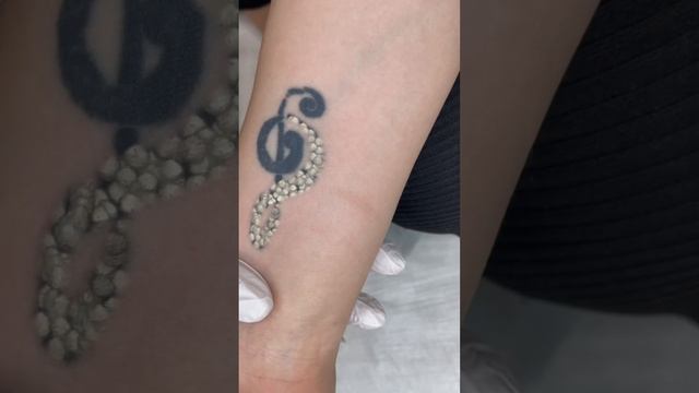 Избавьтесь от татуировки быстро и безопасно! смотреть онлайн