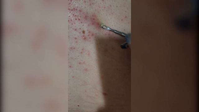Popping huge blackheads and Pimple Popping - Best Pimple Popping Videos 2 смотреть онлайн