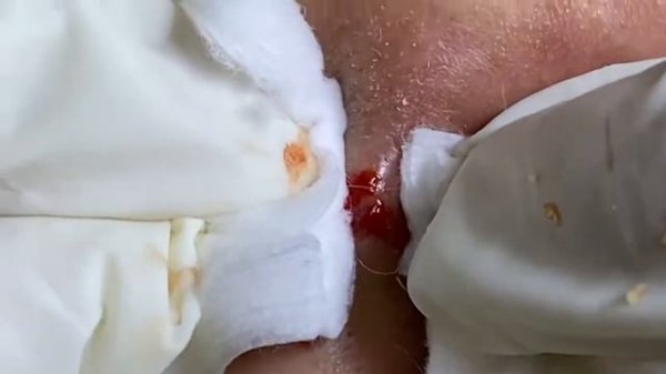 Relaxing Acne Treatment Acnes Treatment 76