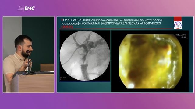 12. Роль пероральной транспапиллярной холангиоскопии в диагностике и лечении механической желтухи смотреть онлайн