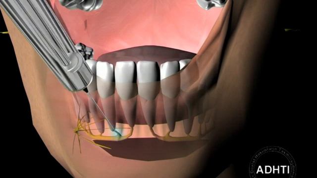 инфильтрационная анестезия на нижней челюсти...infiltration Anesthesia In The Mandible