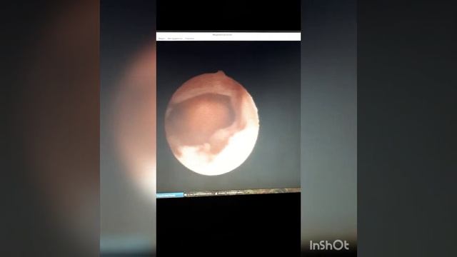 БИОПСИЯ ЭНДОМЕТРИЯ ЩАДЯЩИМ СПОСОБОМ смотреть онлайн