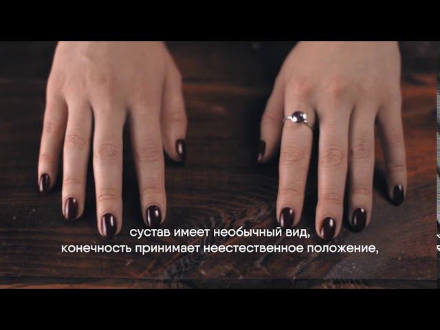 Первая помощь при вывихе смотреть онлайн