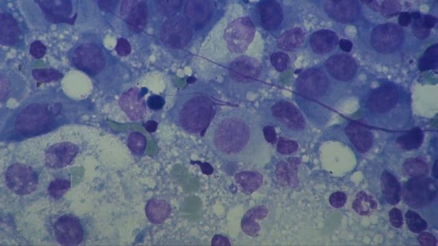Lymph Node Metastases. Impression smear. смотреть онлайн