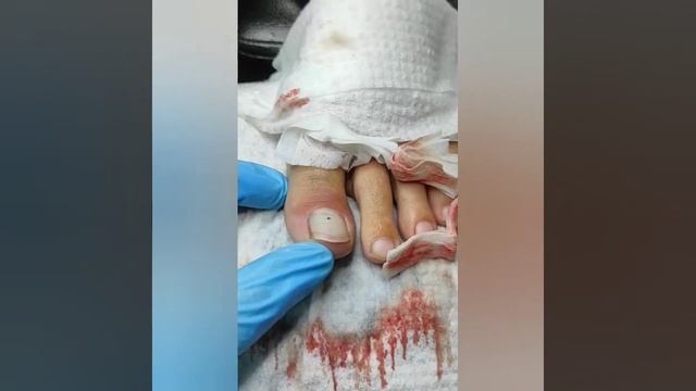 Опять гематома.... смотреть онлайн