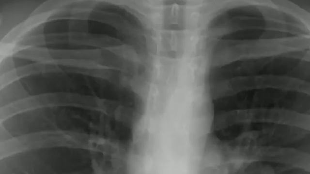 Chest x-ray, Normal, upper mediastinum смотреть онлайн