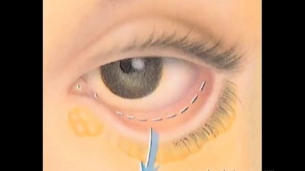 Lower Eyelids Part 2 The Solution The Laser Method