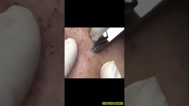 #3 TIK TOK PIMPLE VIDEO COMPILATION US UK | 21st August 2020 смотреть онлайн