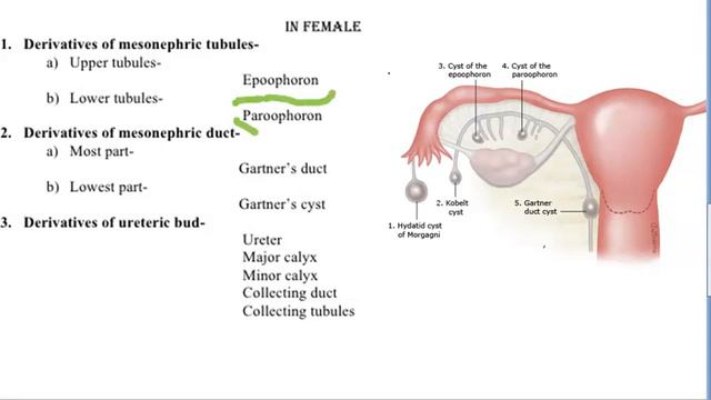 Gynecology 057 Wolffian duct remnant abnormality Gartner duct cyst Hydatid Morgagni Epoophoron смотреть онлайн