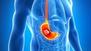 Рак желудка - первые симптомы