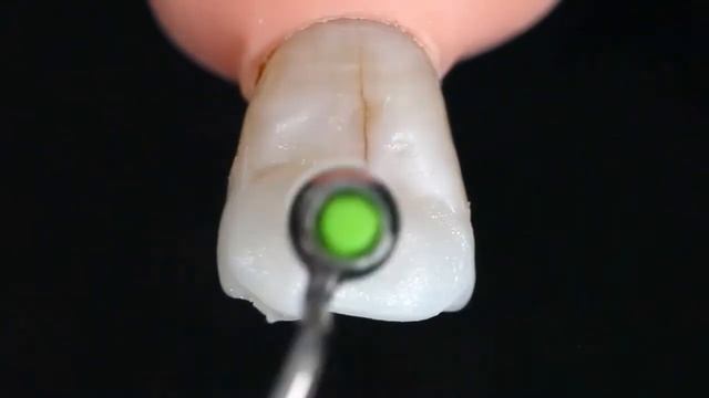 Лінійка IPS  Empress Direct від Ivoclar Vivadent