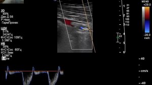УЗИ экстракраниальных отделов брахиоцефальных артерий