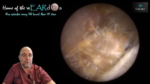 Jumping And Furballs! 220 #ear #earwax #earwaxremoval #earcleaning #asmr #asmrearwax #satisfying