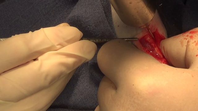 Хирургическое лечение медиального вывиха коленной чашки - транспозиция гребня большеберцовой кости смотреть онлайн