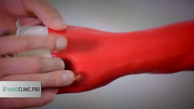 Перелом руки: пластиковый гипс при переломе лучевой кости ОЧЕНЬ УДОБНО! смотреть онлайн