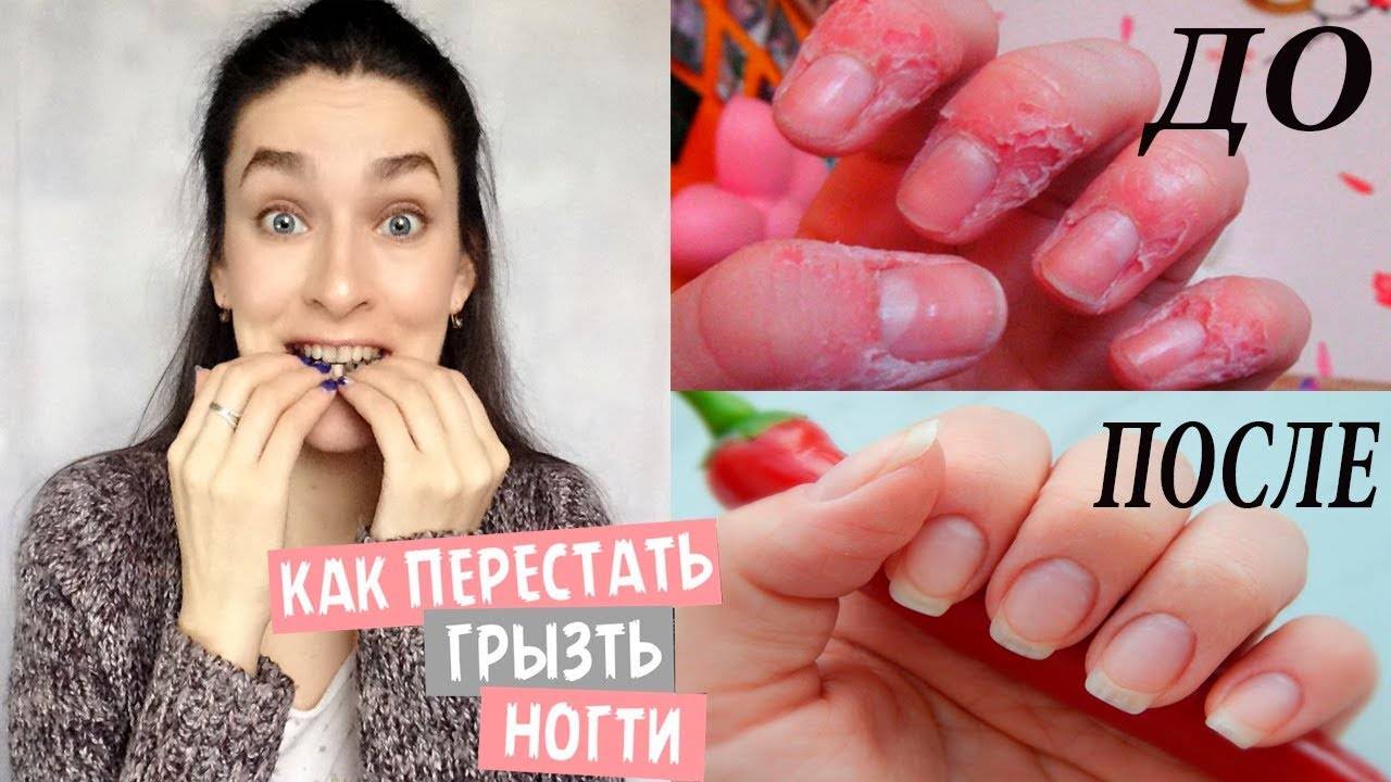 Как перестать грызть ногти и кутикулу? Несколько способов избавиться от вредной привычки смотреть онлайн