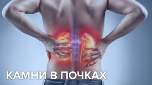 Камни в почках: о каких продуктах надо забыть сейчас, чтобы через 10 лет не найти у себя камни.