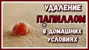 УДАЛЕНИЕ ПАПИЛЛОМ В ДОМАШНИХ УСЛОВИЯХ.mp4